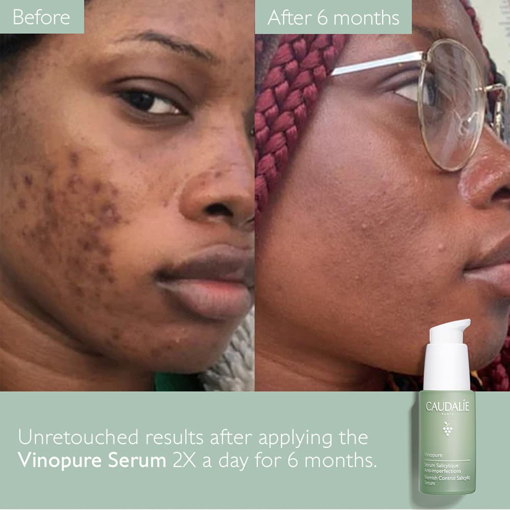 Vinopure Blemish Control Salicylic Serum • 30ml