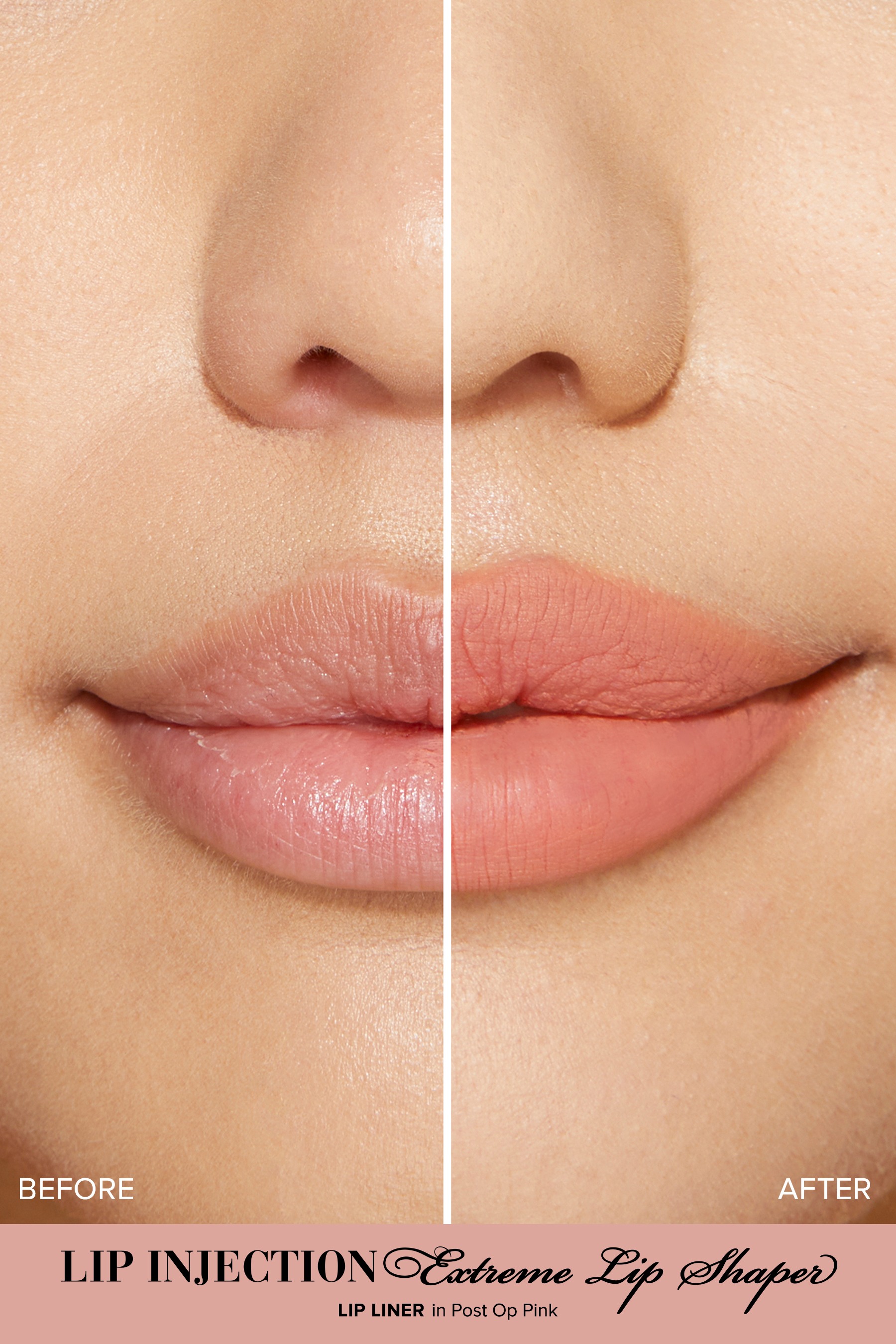 Lip Injection Extreme Lip Shaper •  Post-op Pink