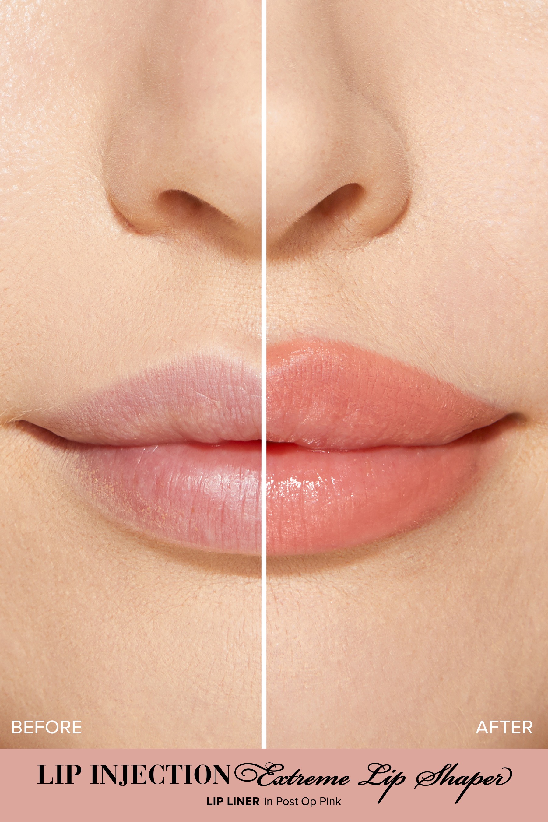 Lip Injection Extreme Lip Shaper •  Post-op Pink