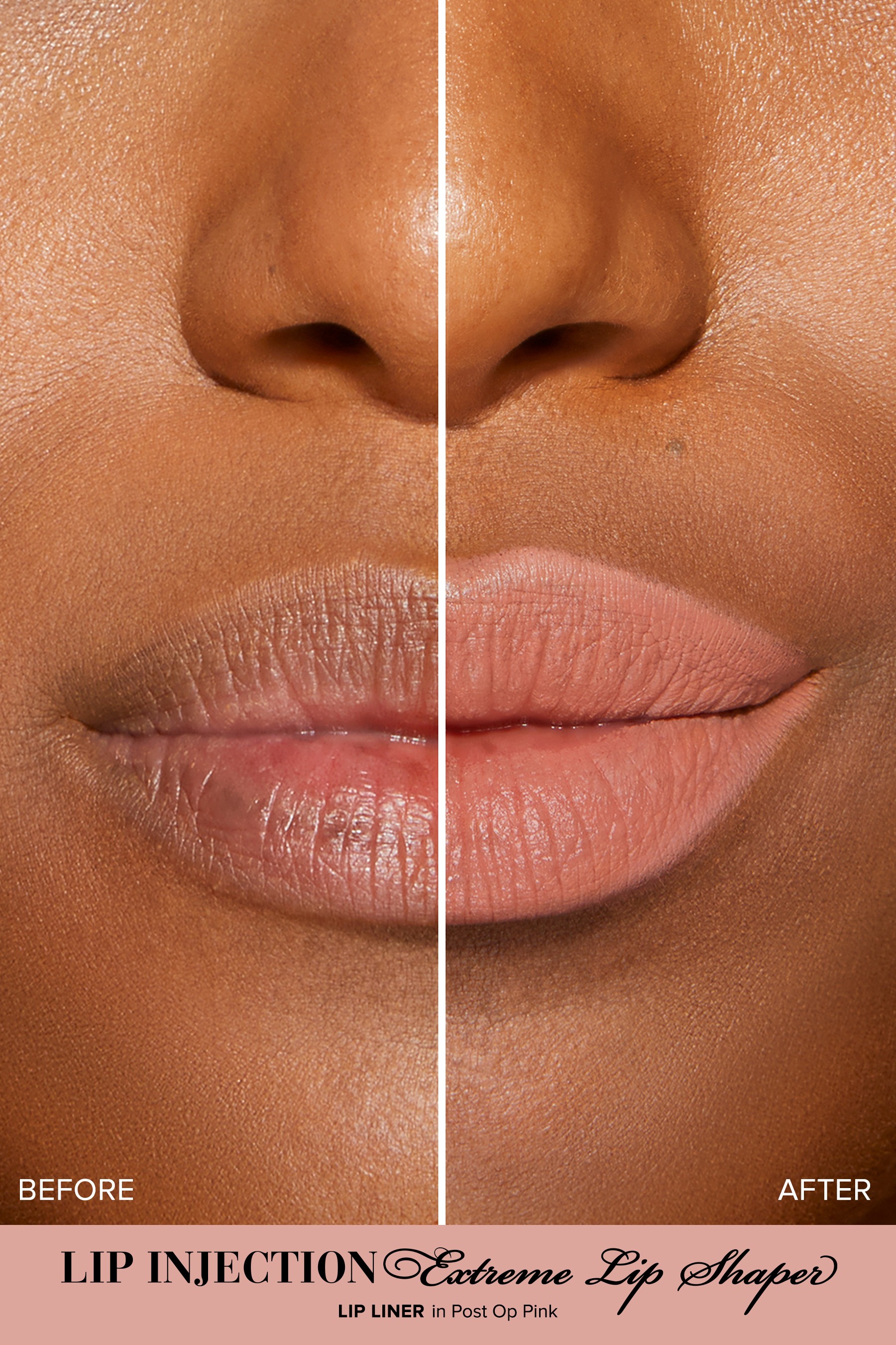 Lip Injection Extreme Lip Shaper •  Post-op Pink