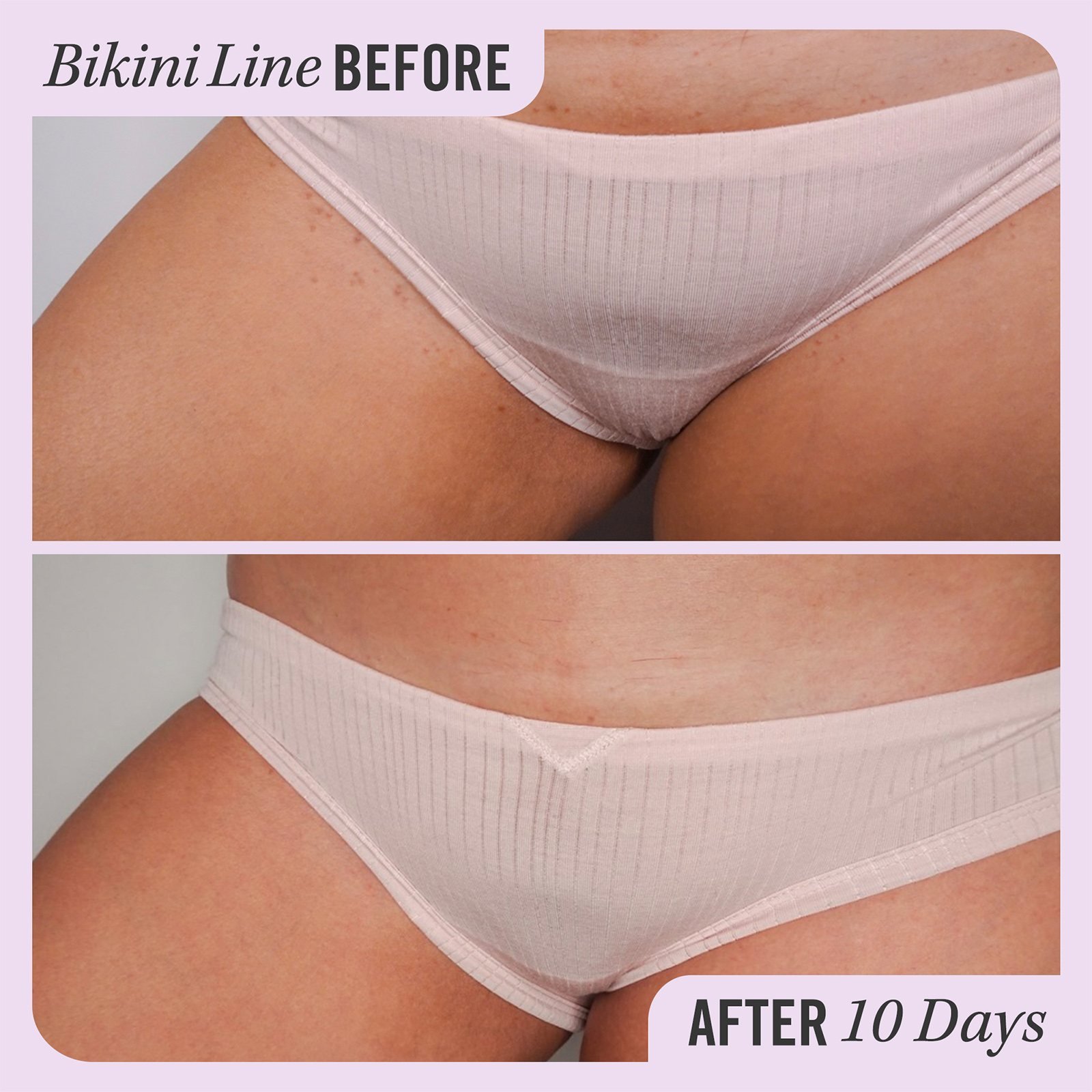 Ingrown Hair Treatment Pads • 28 pads