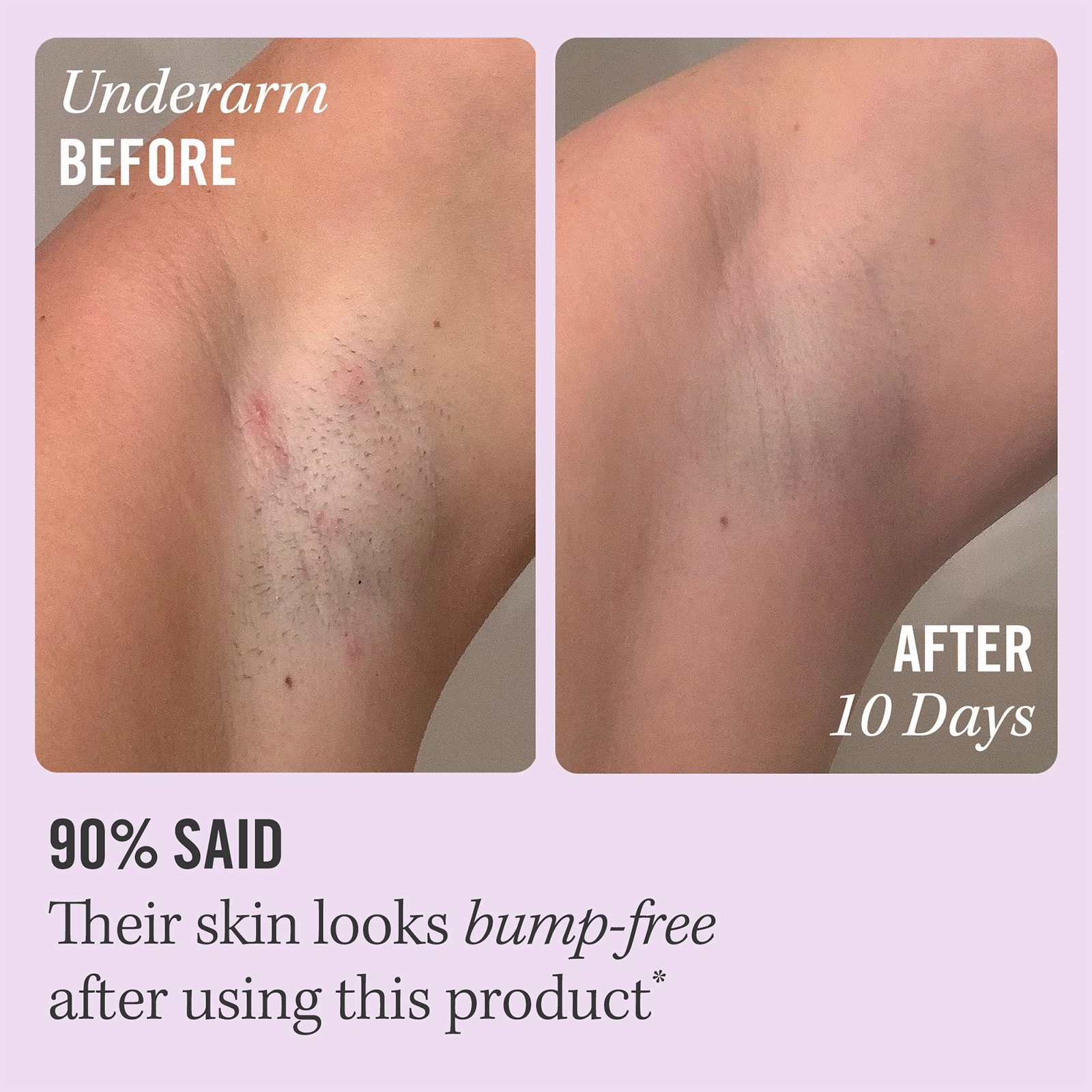 Ingrown Hair Treatment Pads • 28 pads