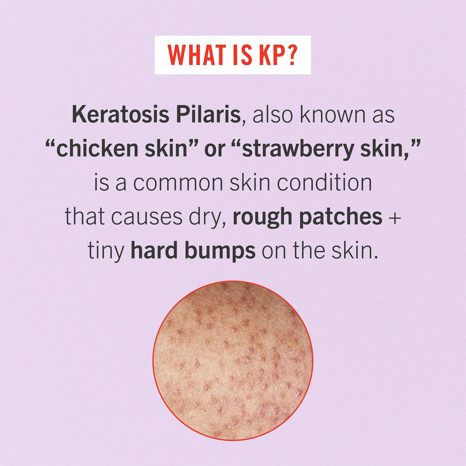 KP Bump Eraser Body Scrub with 10% AHA • 56.7g