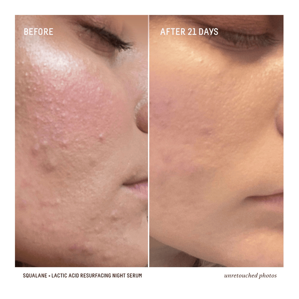 Squalane + 10% Lactic Acid Resurfacing Serum • 30ml