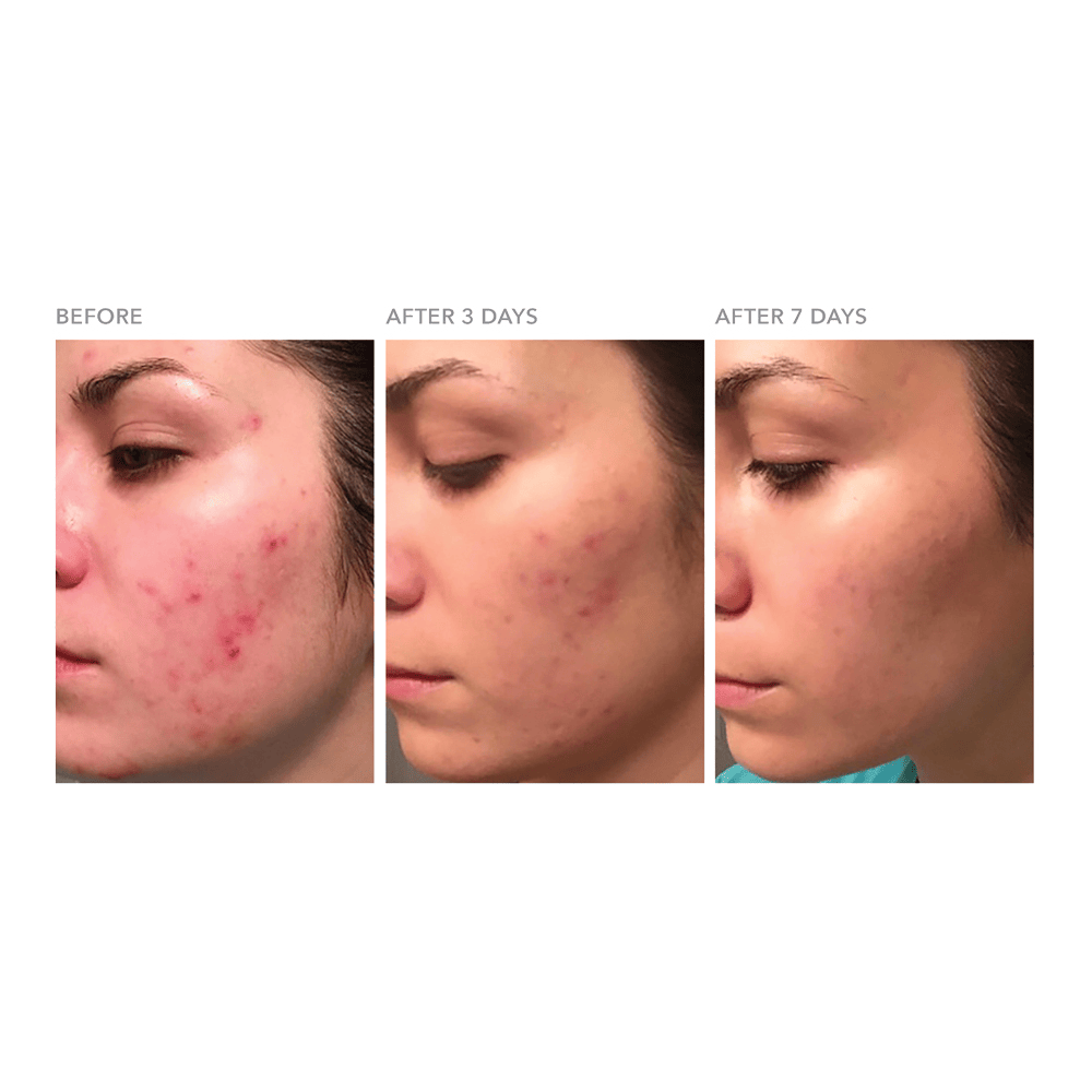 DRx Blemish Solutions Breakout Clearing Gel • 30ml