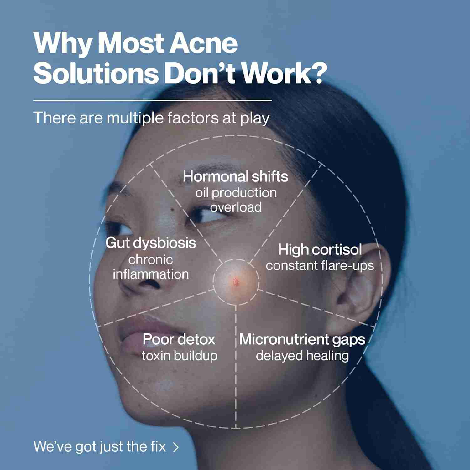 Setu Skin: AcneClear | Target Hormonal & PCOS Acne at the Root | Formulated with BIFIACNEL®, Chasteberry, Chamomile, Magnesium and Supergreens for Gut detox & Skin Health | Green Apple Flavour | 30 Sachets